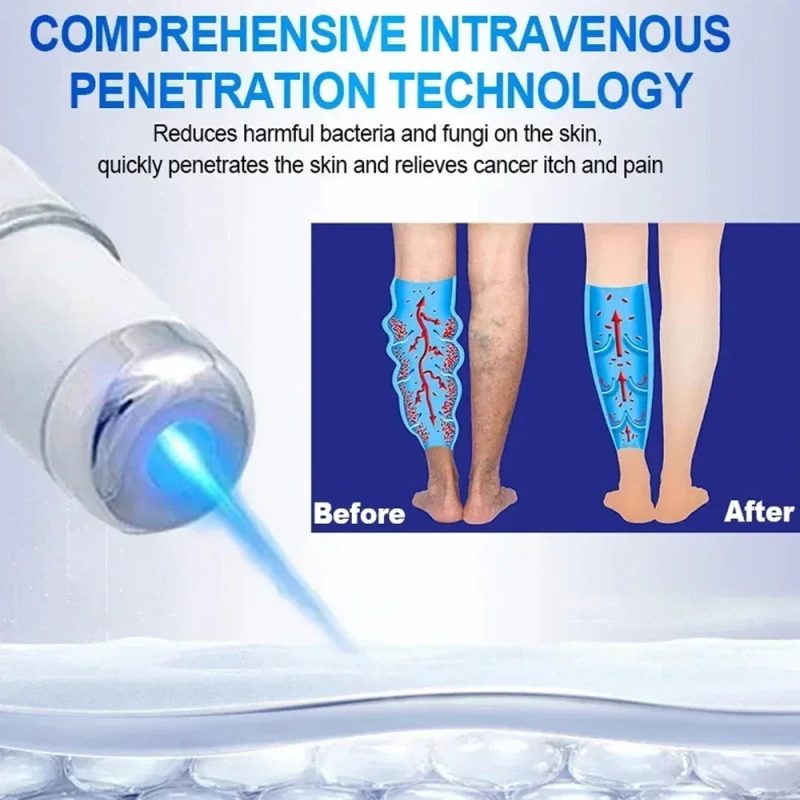 Blue Light Laser Therapy Pen - Image 5